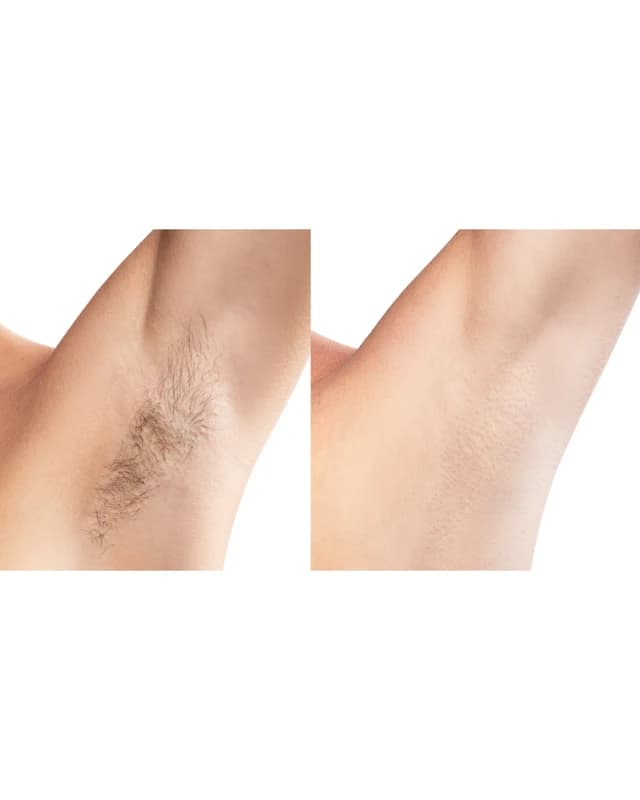Laser hair removal treatment at Radiance Laser & Medical Aesthetics