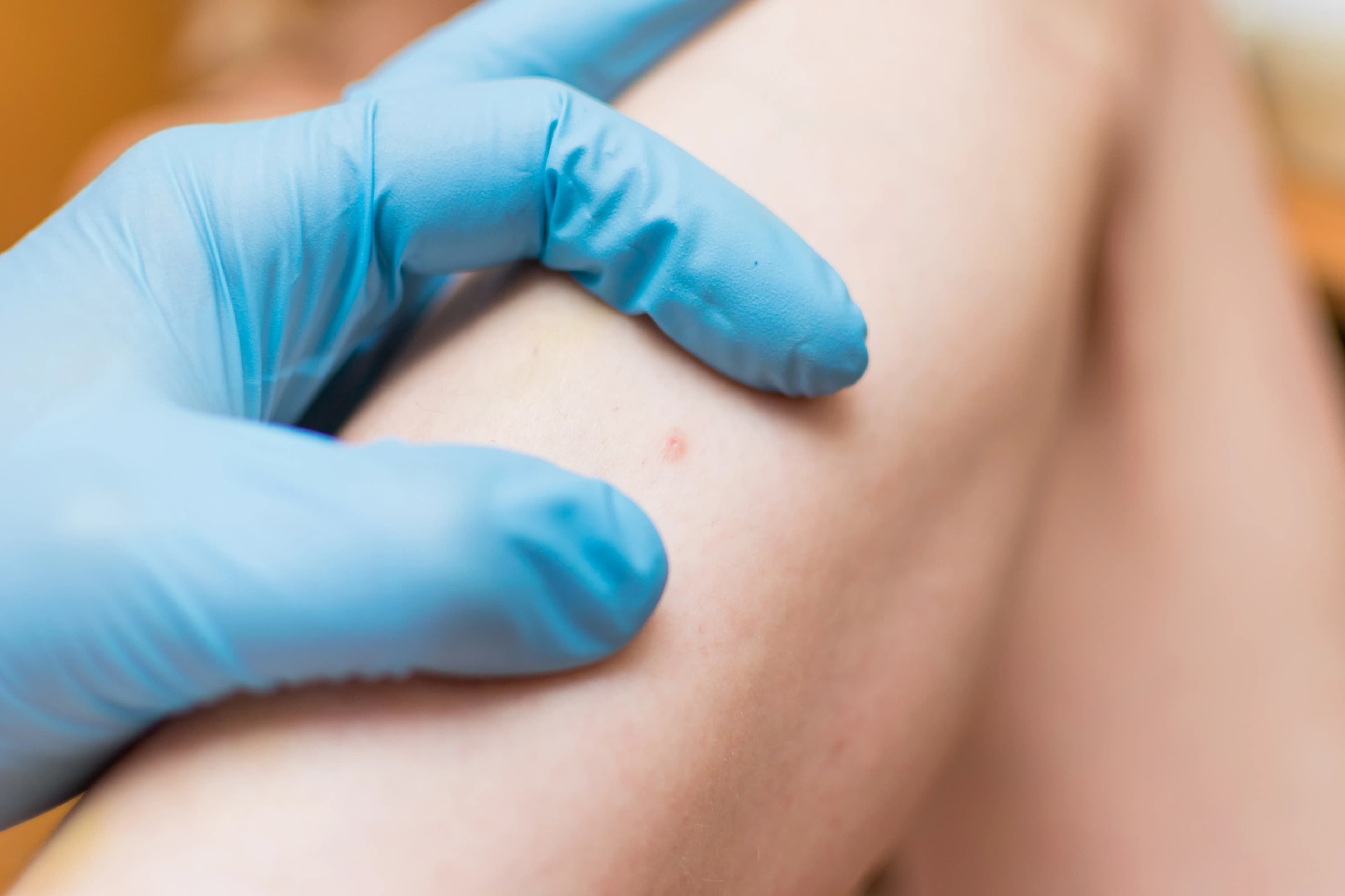 Skin Lesion Removal