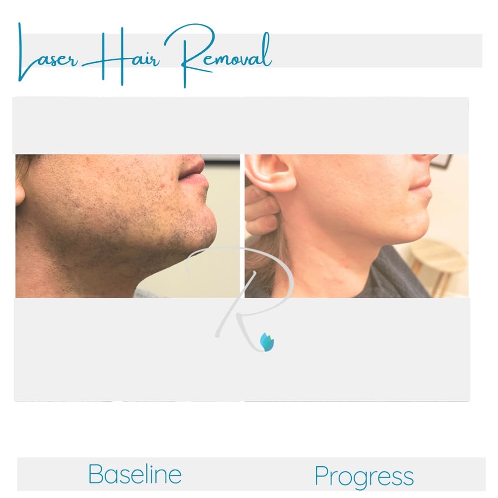 Laser hair removal before and after results at Radiance Laser & Medical Aesthetics Hamilton