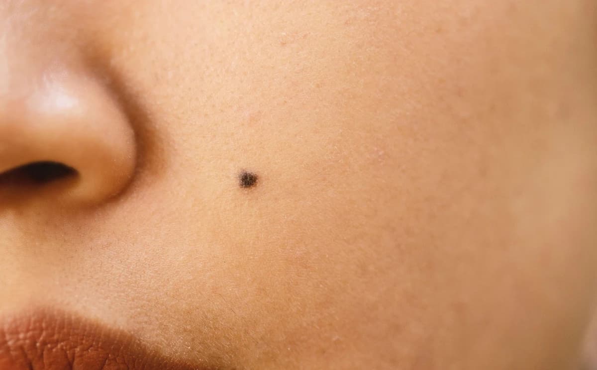 Mole and skin lesion removal in Hamilton at Radiance Laser & Medical Aesthetics