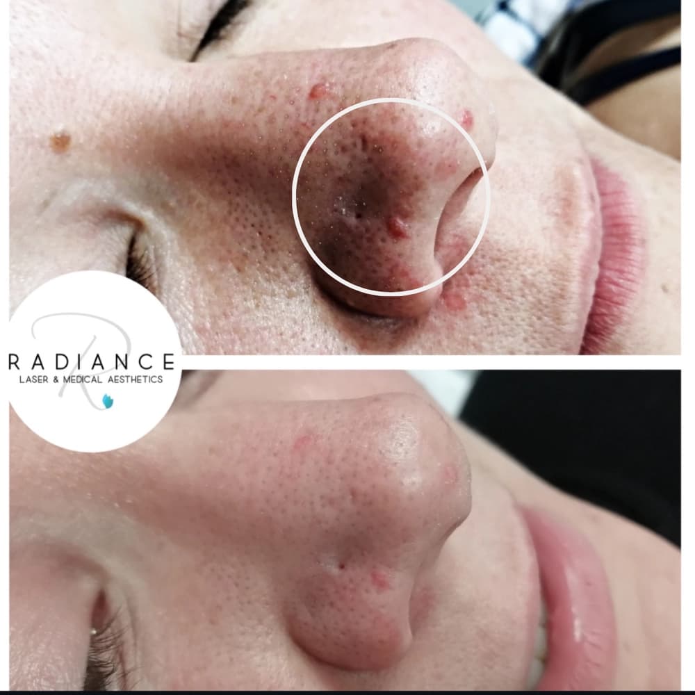 Skin Lesion Removal in Hamilton at Radiance Laser & Medical Aesthetics