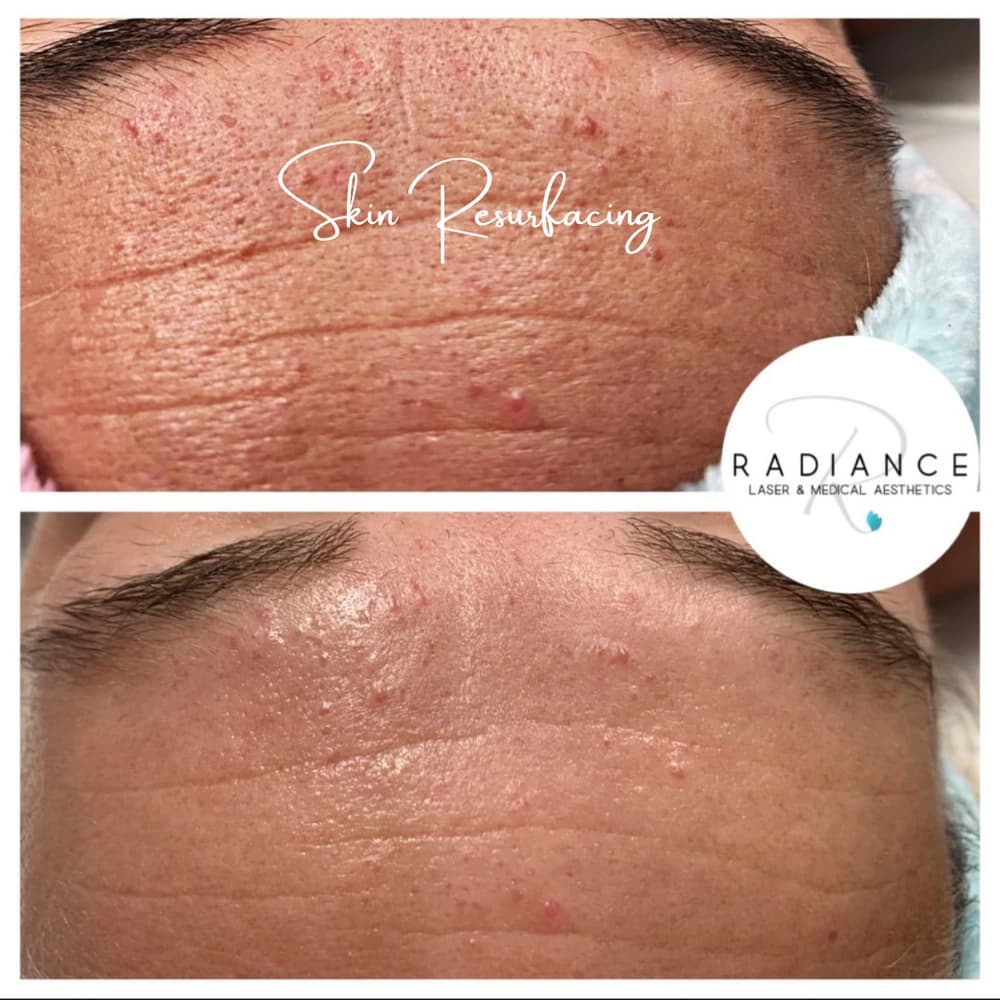 Skin resurfacing before and after results at Radiance Laser & Medical Aesthetics Hamilton