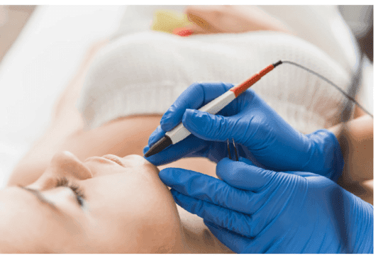 Electrolysis hair removal treatment in Hamilton at Radiance Laser & Medical Aesthetics