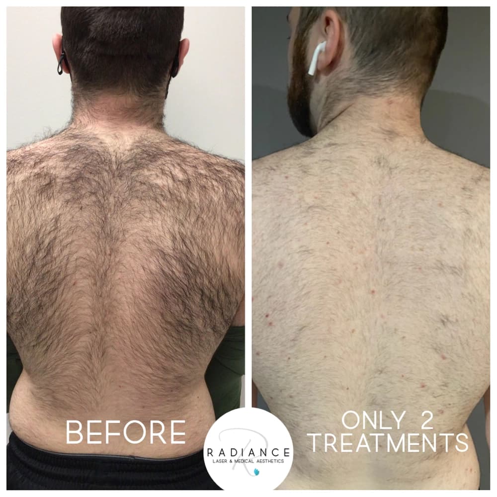Laser hair removal results on the back at Radiance Laser & Medical Aesthetics Hamilton
