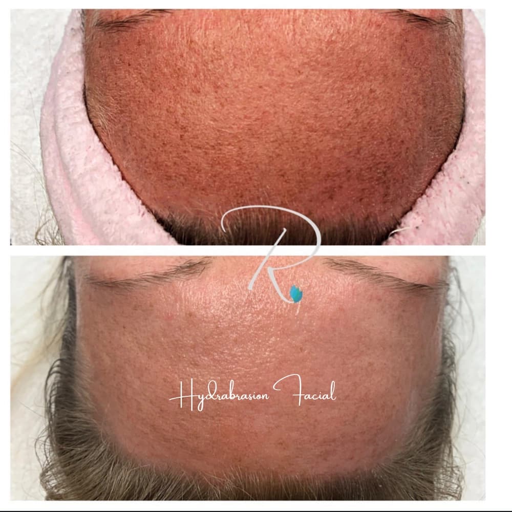HydraBrasion facial treatment in Hamilton at Radiance Laser & Medical Aesthetics