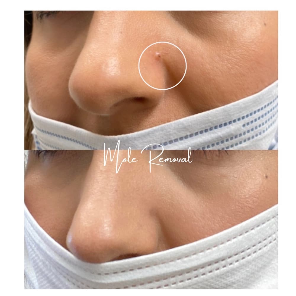 Skin lesion removal before and after results at Radiance Laser & Medical Aesthetics Hamilton