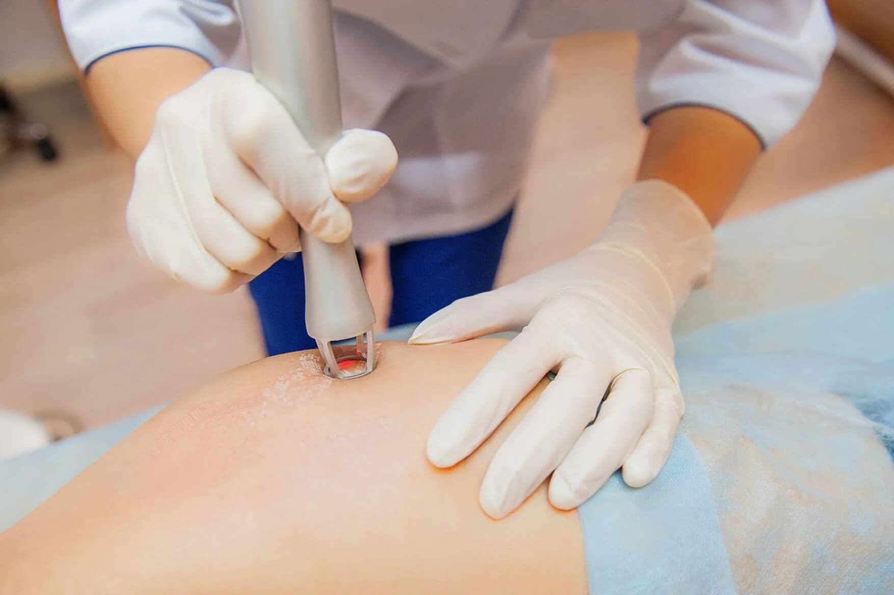 Stretch mark reduction skin resurfacing in Hamilton at Radiance Laser & Medical Aesthetics