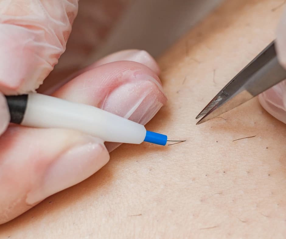 Comparing permanent hair removal and laser hair reduction at Radiance Laser & Medical Aesthetics