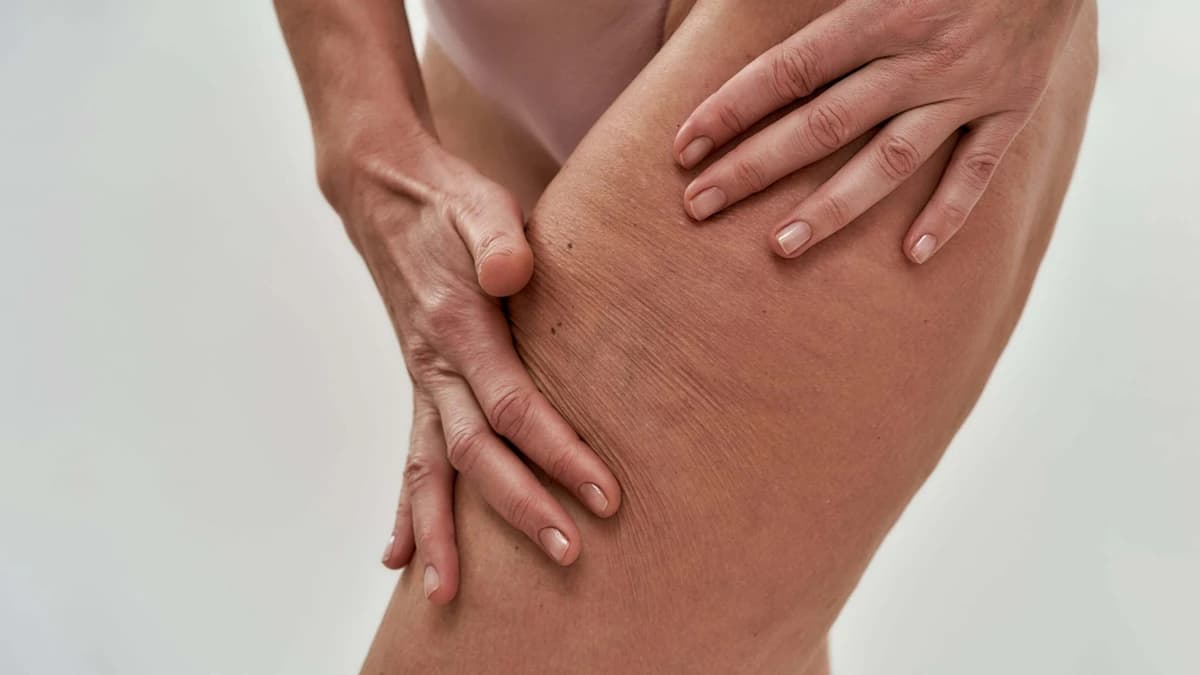 Cellulite reduction treatment in Hamilton at Radiance Laser & Medical Aesthetics
