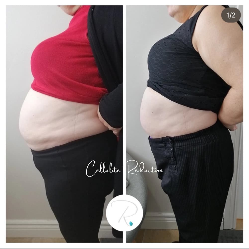 Skin tightening and cellulite reduction results at Radiance Laser & Medical Aesthetics Hamilton