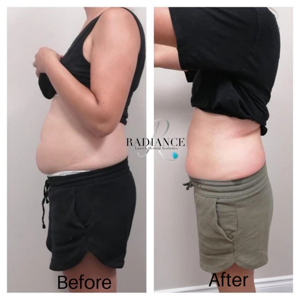 Skin tightening treatment in Hamilton at Radiance Laser & Medical Aesthetics