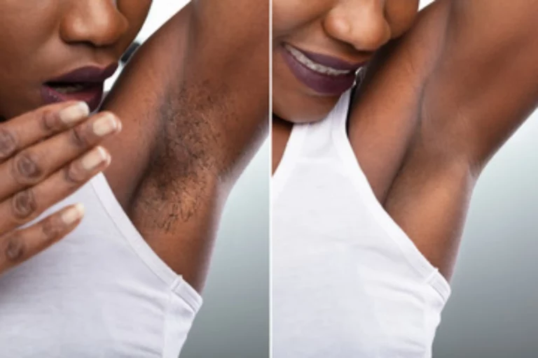 arm-hair-removal-before-after