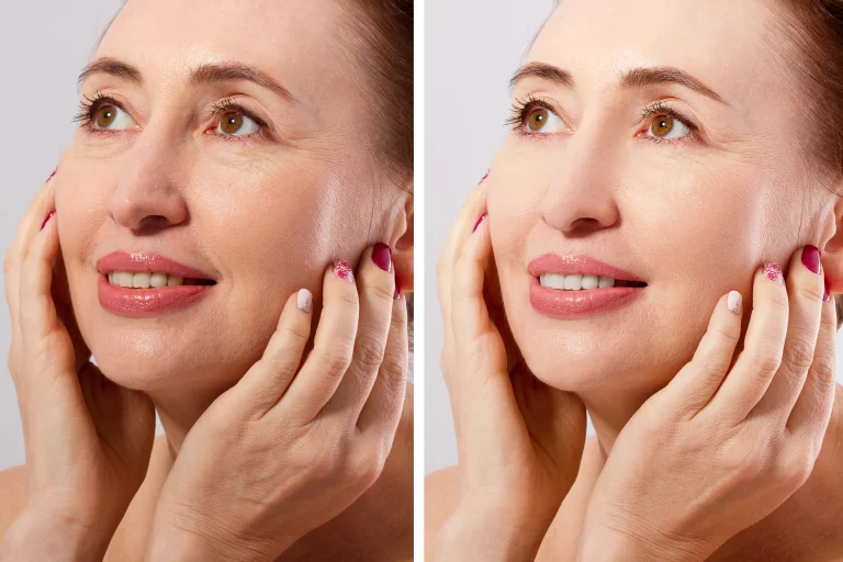 skin-rejuvenation-before-after