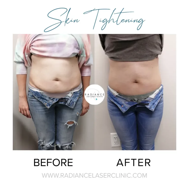 skin-tightening-process-before-after
