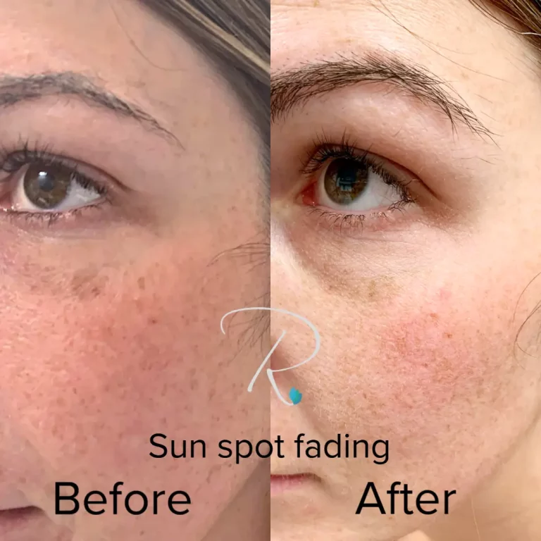 sun-spot-reduction-before-afte