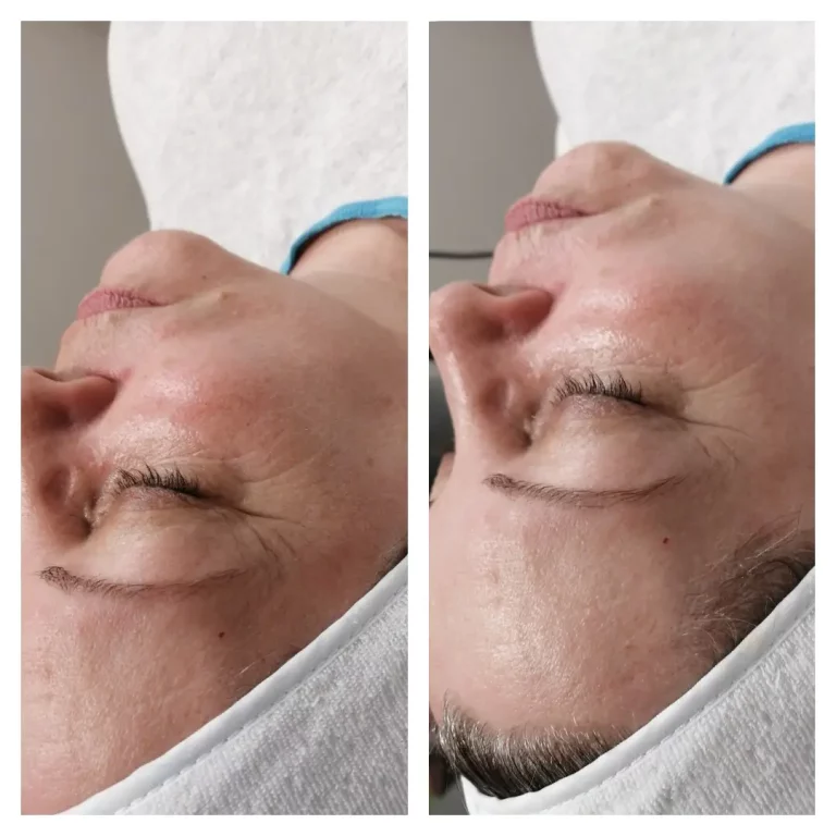 wrinkle-reduction-before-after