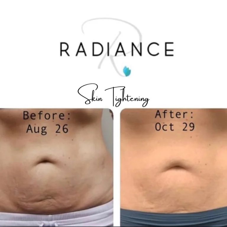 cellulite-reduction-before-after