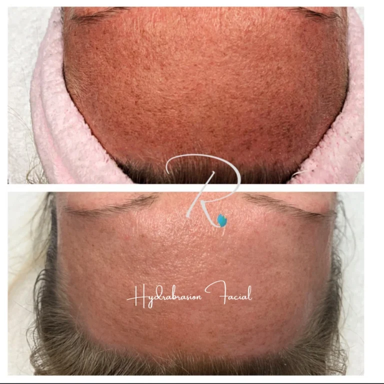 dydrabrasion-facial