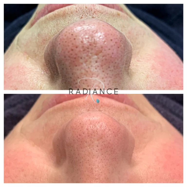 facial-blackhead-removal