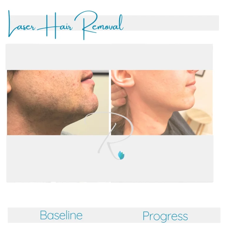 laser-hair-removal-before-after