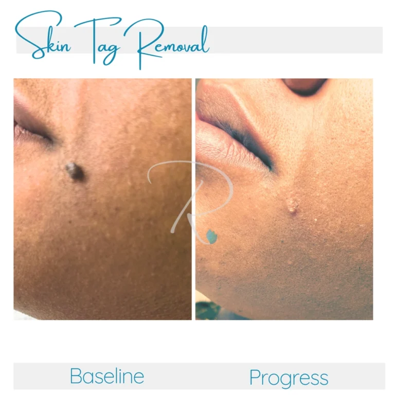 skin-tag-treatment