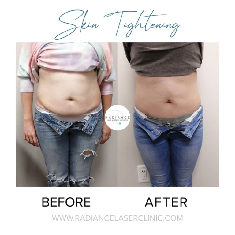skin-tightening-before-after